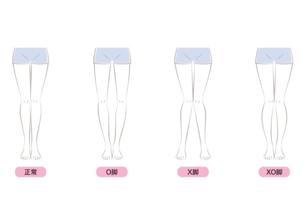 脚の形のタイプ（正常・O脚・X脚・XO脚）